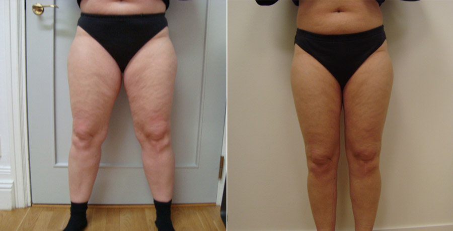 body jet fettsugning body jet fettsugning