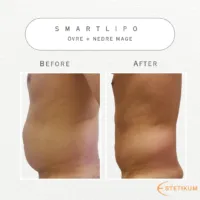 Före och efter bild på fettsugning av magen