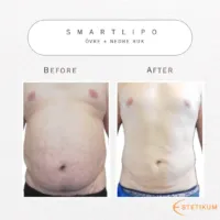 före och efter bild på buken