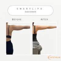 Före och efter närbild på fettsugning med smartlipo på överarmar