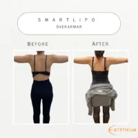 Före och efter bild på fettsugning med smartlipo på överarmar