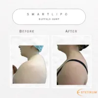 Före och efter bild på smartlipo av buffalo hump