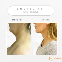 Före och efter bild på fettsugning av haka och käklinjen