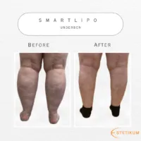 Före och efter bild på fettsugning av underben