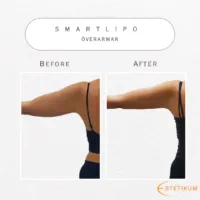 Närbild av fettsugning av överarmar