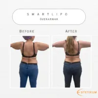 Bild på fettsugning av överarmar