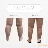 före och efter bild på baksidan av underbenen