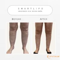 före och efter bild framifrån av underbenen