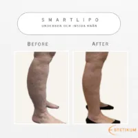 före och efter bild på sidan av underbenen