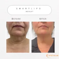 En före och efter bild på smartlipo av nacken, bild tagen framifrån