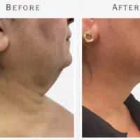 En före och efter bild på smartlipo av nacken, bild på höger profil