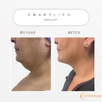 En före och efter bild på smartlipo av nacken, bild på vänster profil