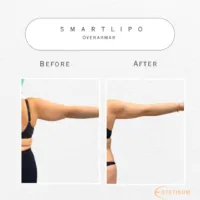 fettsugning av överarmar fettsugning av överarmar